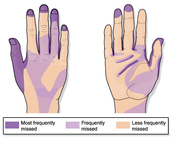 A diagram of two hands showing the most frequently missed areas when handwashing, which include the fingertips, back on the thumb and between then thumb and index finger.